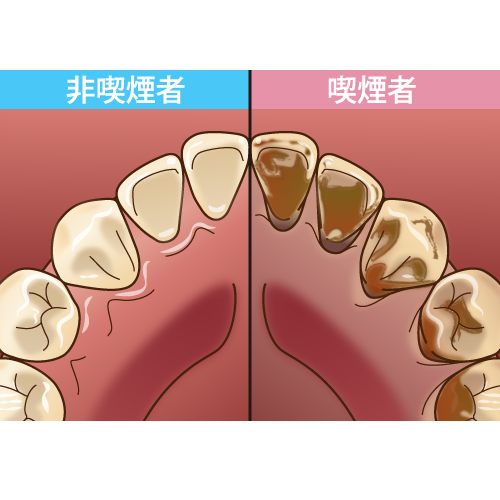 どうして歯に着色するの？