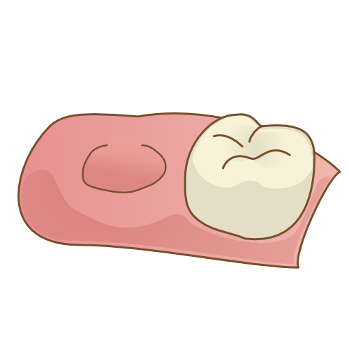 抜歯したら喫煙はNG?