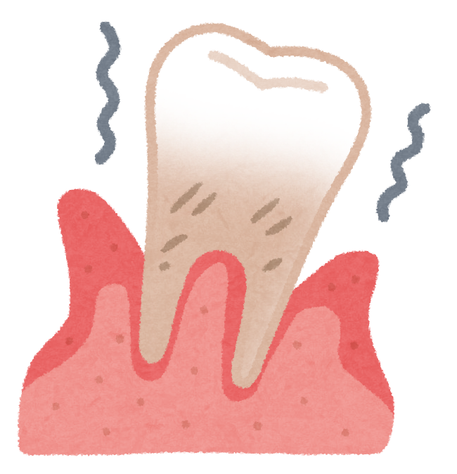 実際、歯周病ってなんなの？？