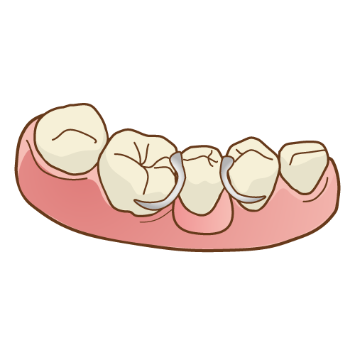 入れ歯って？？そのメリット！
