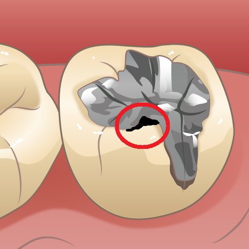 一度治療したのにまたむし歯！？