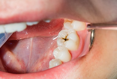 むし歯の治療