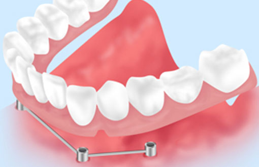 入れ歯（義歯・デンチャー）治療について