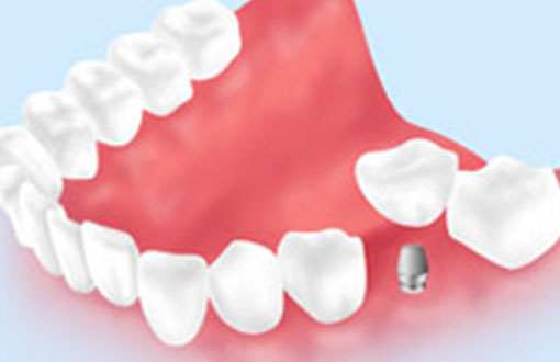 インプラント治療とは
