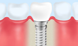 インプラント