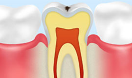 ごく初期のむし歯【CO】