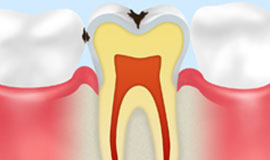 エナメル質のむし歯【C1】