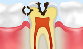 象牙質のむし歯【C2】