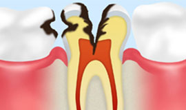 神経に達したむし歯【C3】