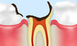 歯根に達したむし歯【C4】