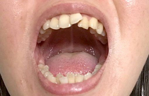 歯並びの乱れが招く問題